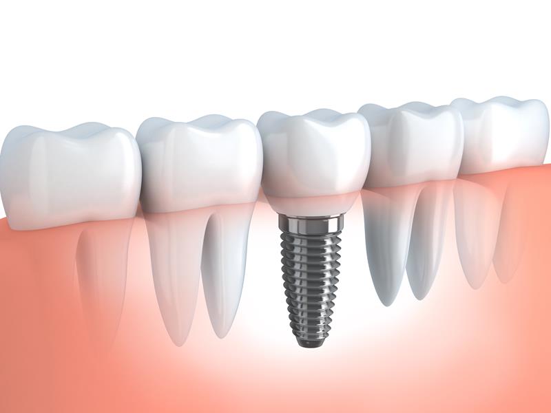Dental Implants  West Hollywood, CA 