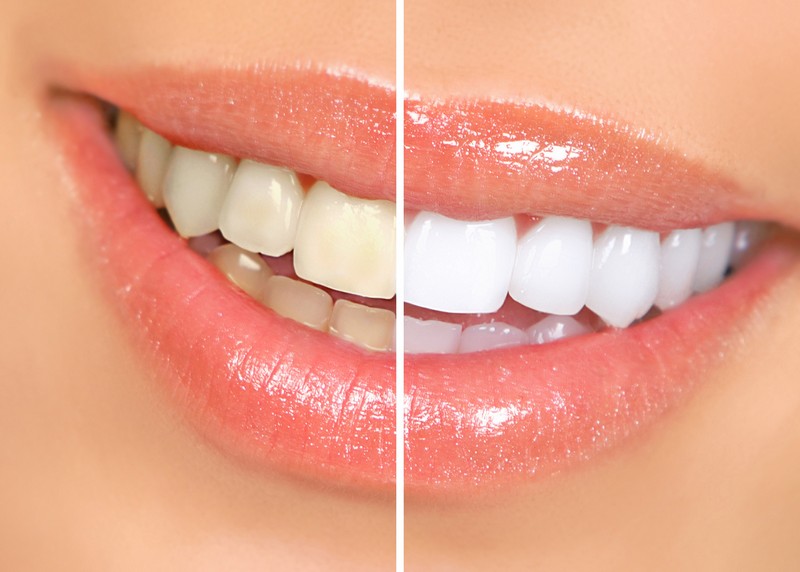 Teeth Whitening West Hollywood, CA